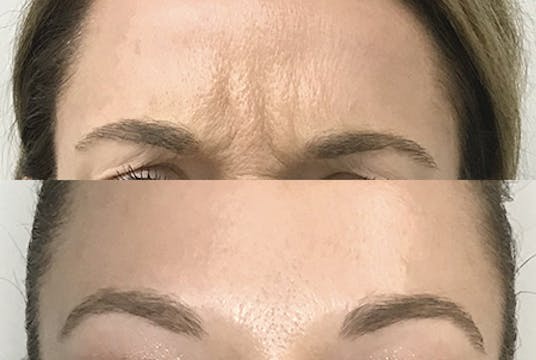 Before and After Wrinkle Relaxer to Frown and Forehead