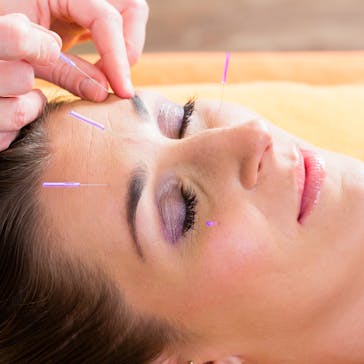 Alexandria Physio and Pilates - Acupuncture